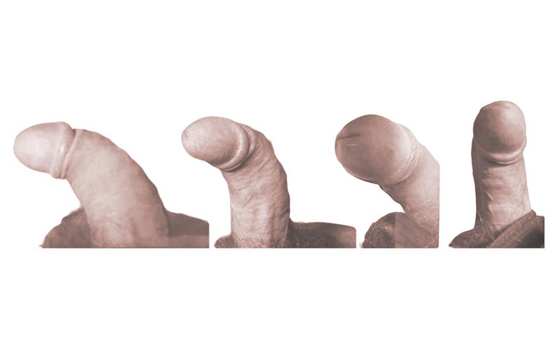 pene curvo caso 10