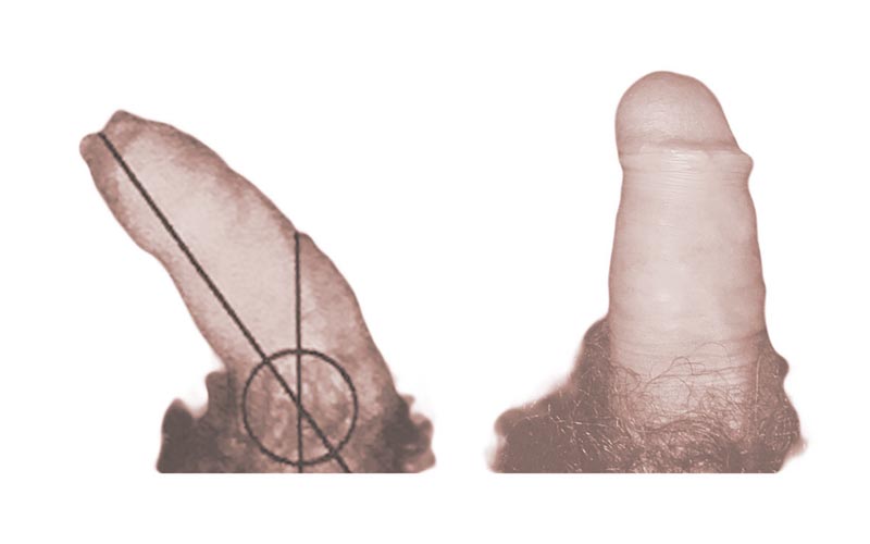pene curvo caso 11
