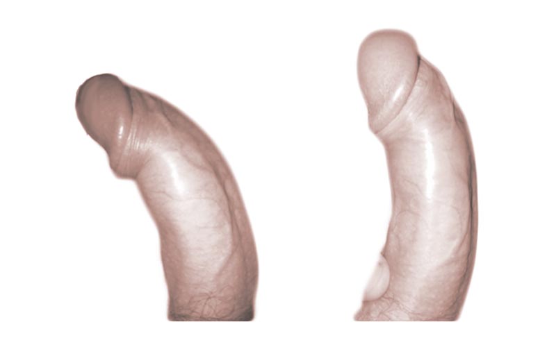 pene curvo caso 14