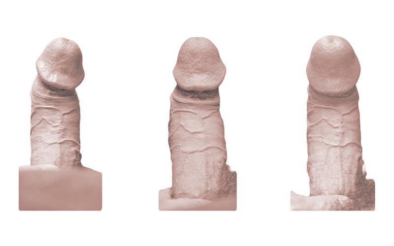 pene curvo caso 3