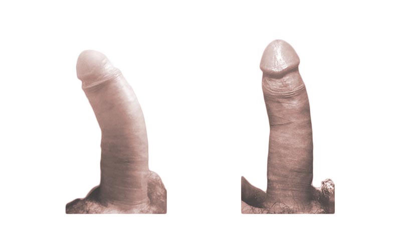 pene curvo caso 5