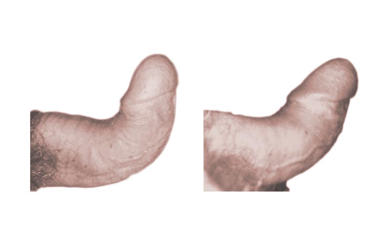 pene curvo caso 9